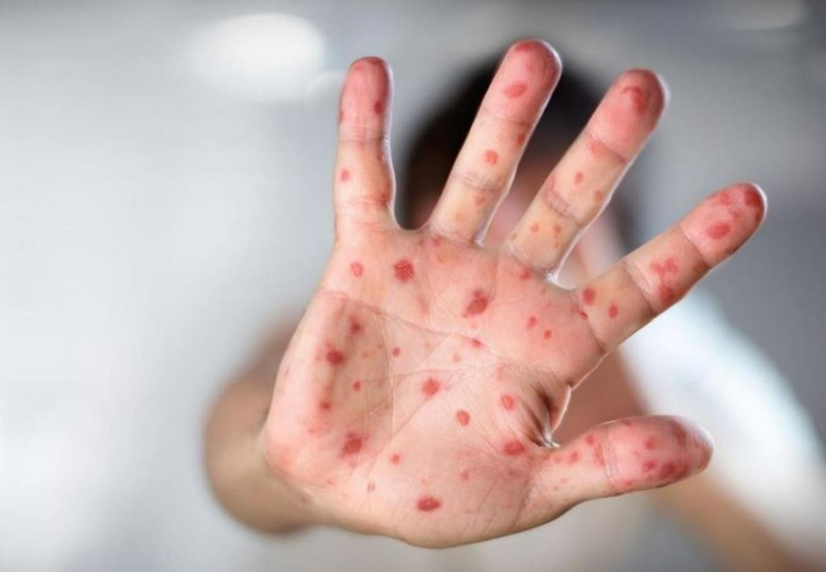 Viruela del mono. Foto: NA.