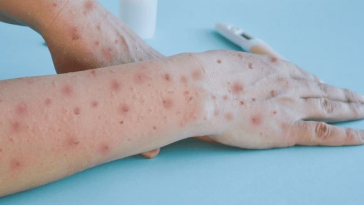 Los síntomas de la varicela zóster son similares a los de la viruela del mono. Foto: NA.